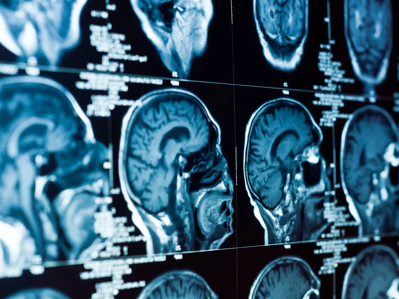 Multiple MRI scans of a human brain displayed on a monitor, showing side profiles of the brain's structures in high detail.